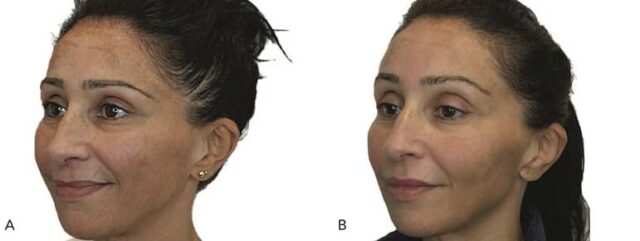 huidverbetering spuiten