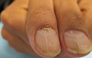 Gedeeltelijke afwezigheid van cuticula, onychorrhexis en onychoschizis, rechts op dig 1: rode lunula