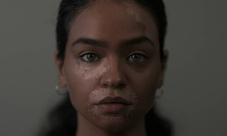 Vitiligo: Causes, Treatment & New Perspectives